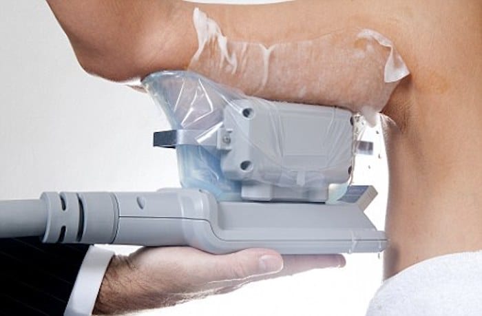 fat freezing arms Richmond