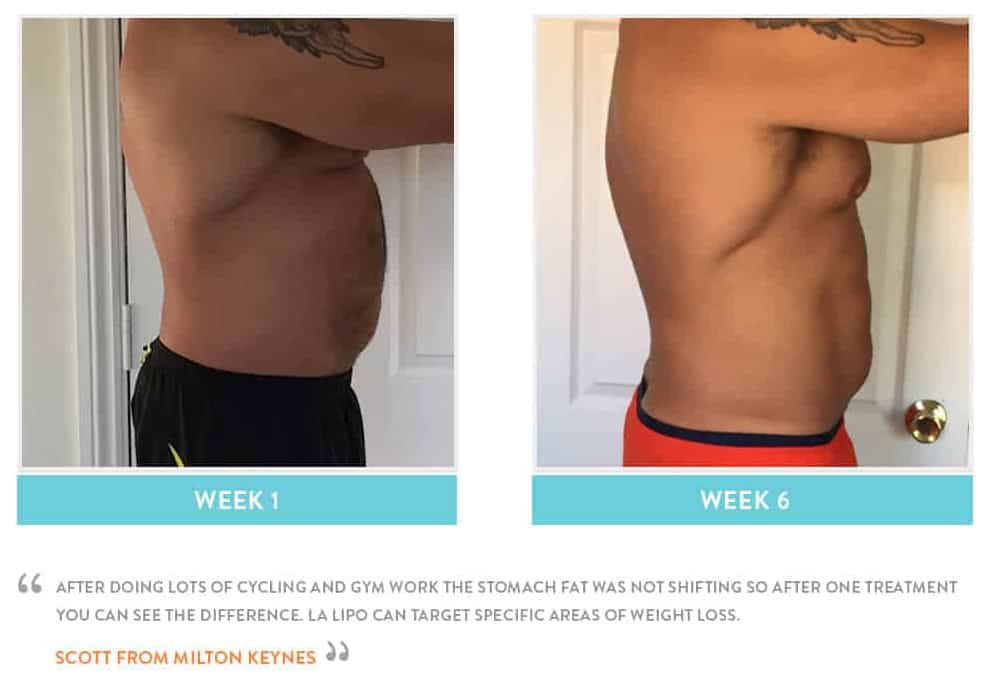Before & After Stomach Fat Richmond