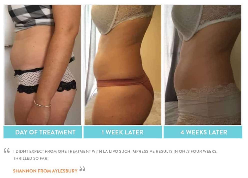 before, Cryolipolysis Richmond
