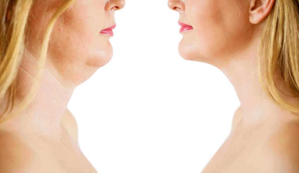 Double Chin treatment Richmond before and after results