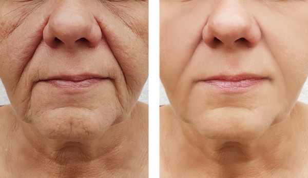 Learn more about Morpheus8 Treatment Richmond today!