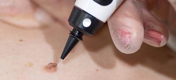 After Skin Tag Removal Richmond