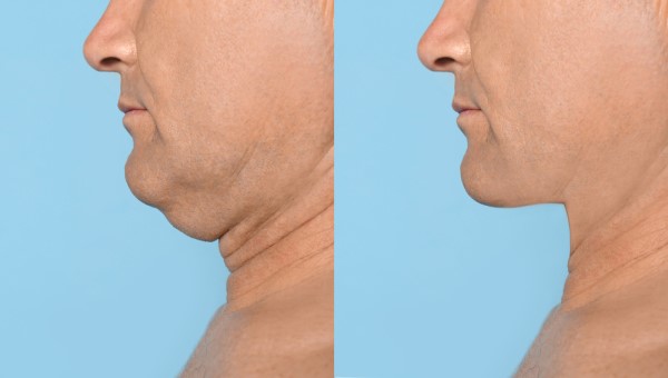 Which Non-Surgical Treatments Work Best for Jowls and Loose Skin Richmond?