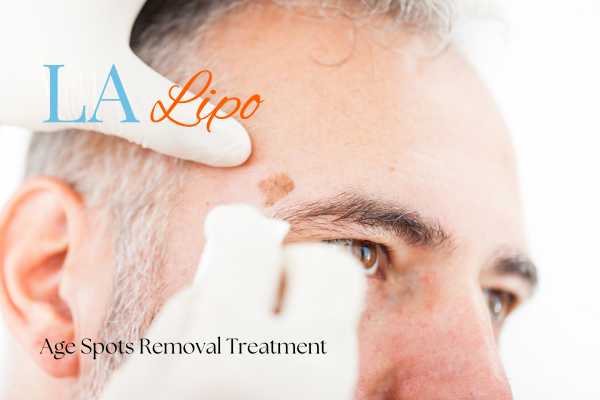 What Are the Most Effective Treatments for Age Spots Richmond?