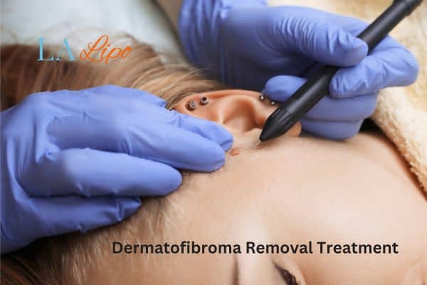 Dermatofibroma Removal Treatment Richmond