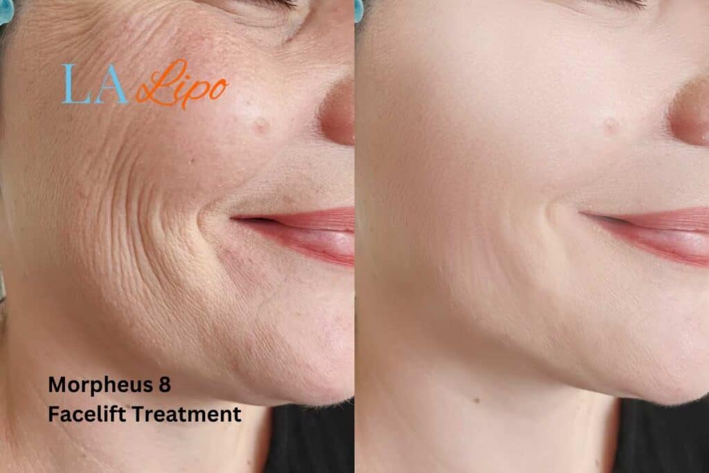Morpheus8 Treatment Richmond for flawless skin! Call us today!