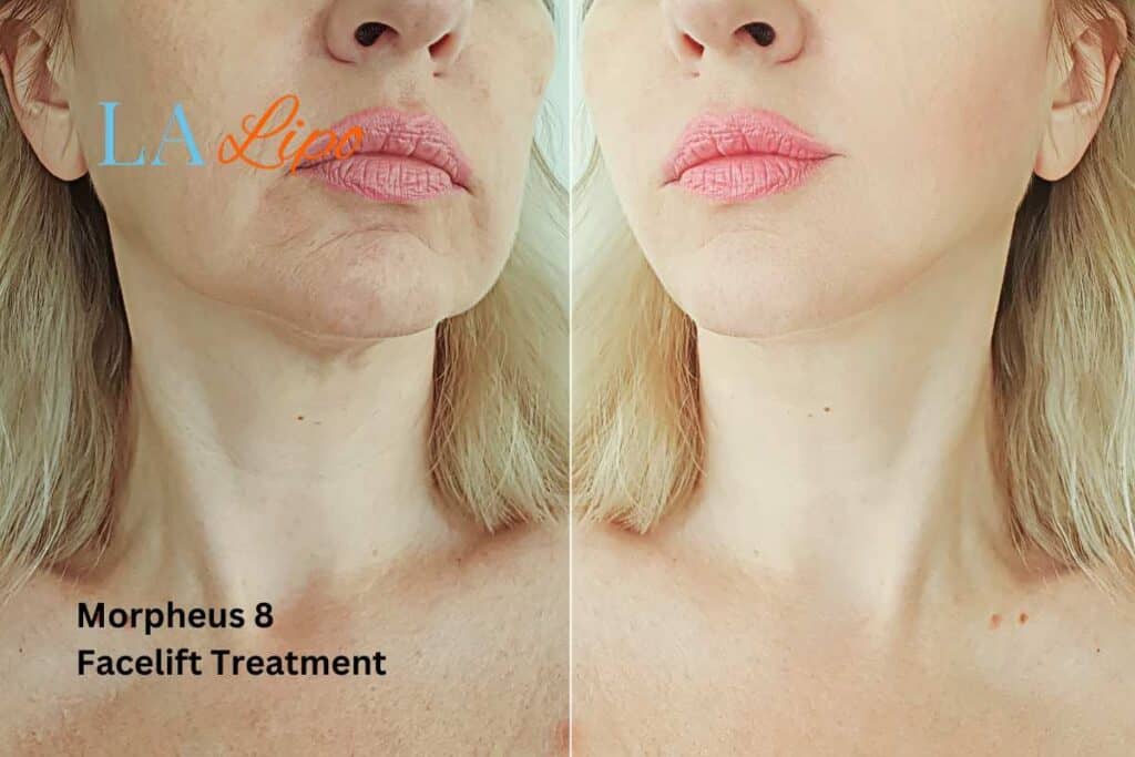 Turn back time with Morpheus8 Treatment Richmond