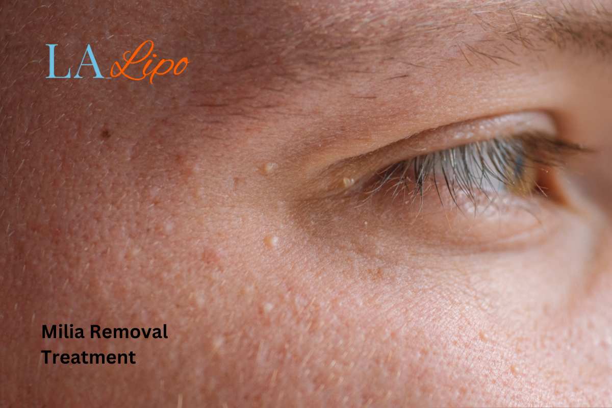 Cryopen Milia Removal: Is It the Easiest and Safest Option Richmond?