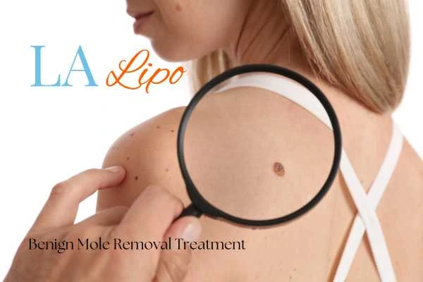 Woman having her inspection of blemish before mole removal Richmond