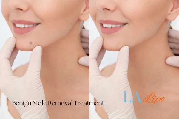 Before and after mole removal Richmond treatment