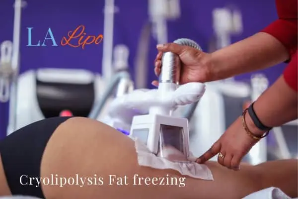 women getting fat freezing Richmond