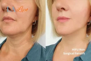hi-fu for wrinkles Richmond before and after results