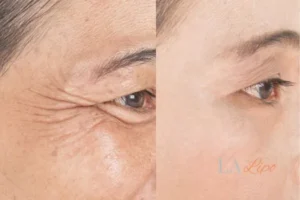 Before and after results of woman - HI-fu wrinkles reduction treatment Richmond