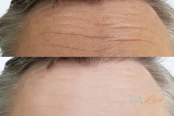 results of HIFU Richmond on mans forehead to help reduce lines and wrinkles