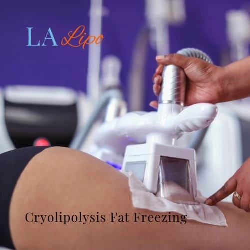 fat freezing - Cryolipolysis Richmond