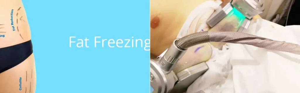 multi areas of a persons body having coolsculpting Richmond treatment