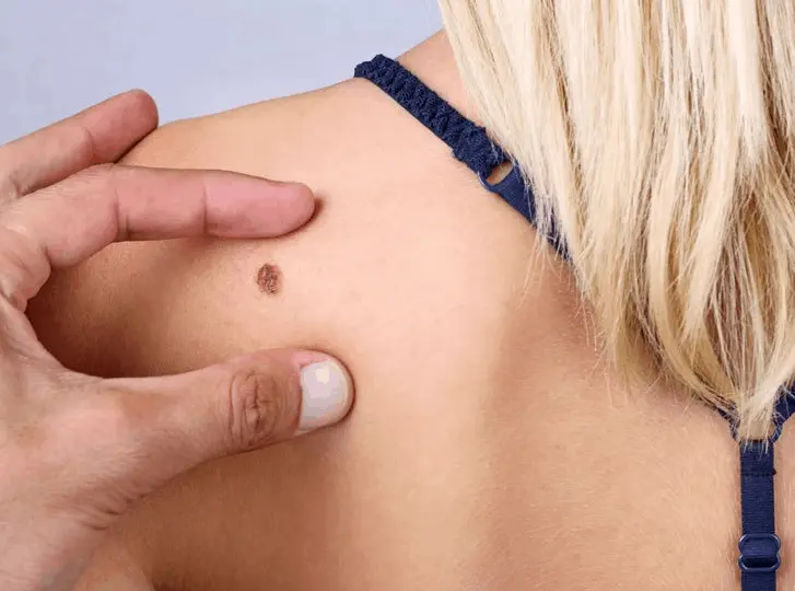 woman having mole removal Richmond consultation before treatment.