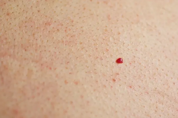 close up of a cherry angioma Richmond