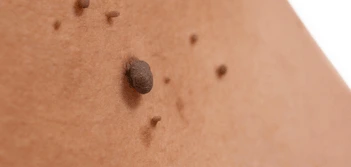 image of a skin tag Richmond