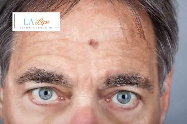Solar Lentigo Removal Richmond image of man with mark on his forehead