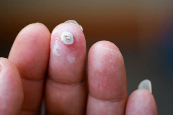 wart on person finger - cryotherapy to treat from LA LIPO Richmond
