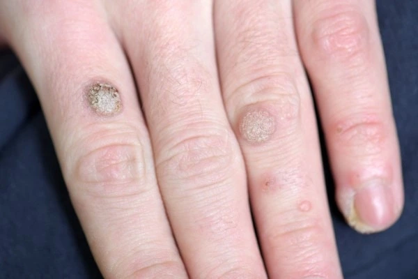 photo of warts on person hand - see wart removal Richmond from LA LIPO