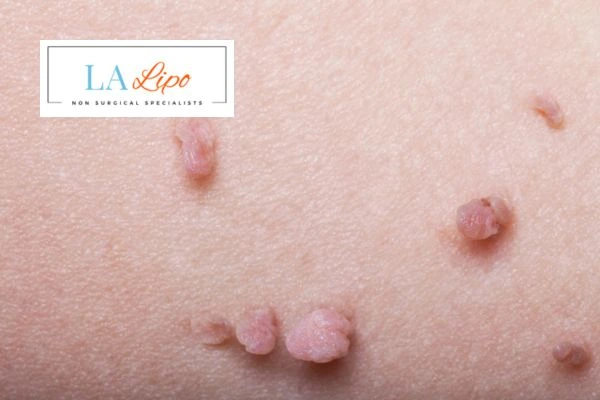Does cryopen skin tag removal Richmond hurt? Find out now call our team today!