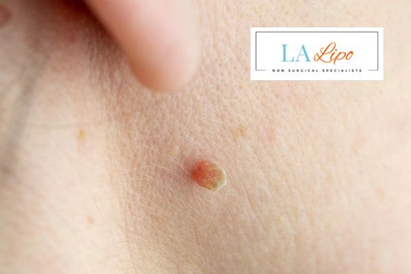 Book skin tag removal Richmond today speak to our team now!