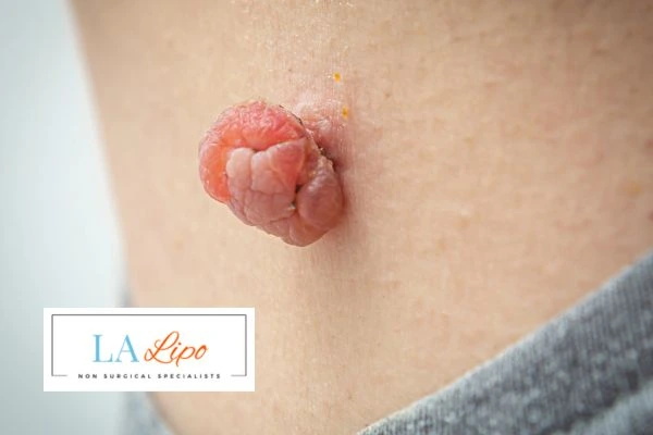 Interested in skin tag removal Richmond? Concerned about the pain? Find out more today!