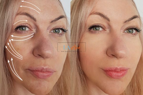 Morpheus 8 results Richmond face lift.