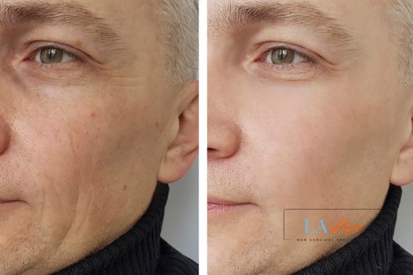 See the amazing results of Morpheus8 Treatment Richmond!