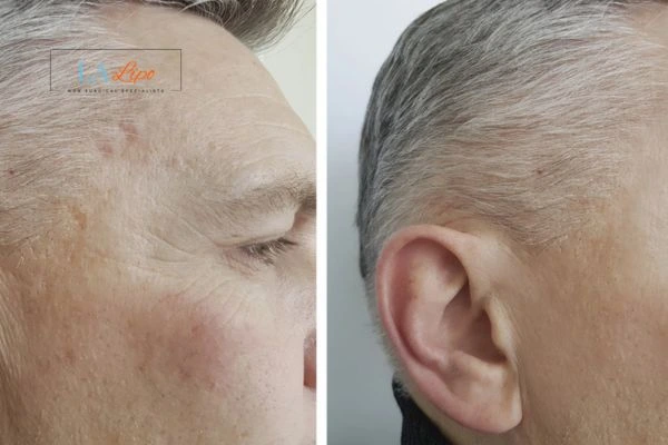 Mens Before & After Morpheus 8 Results Richmond