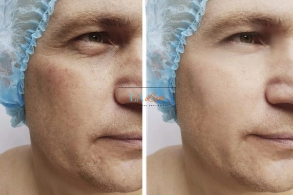 Before and after Morpheus 8 Results Richmond
