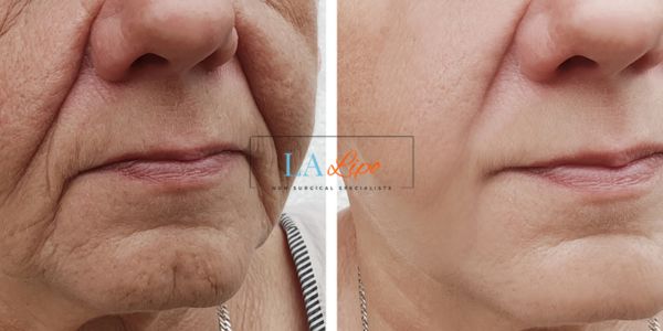 Older lady deeper wrinkle reduction - LA LIPO Morpheus 8 Results Richmond
