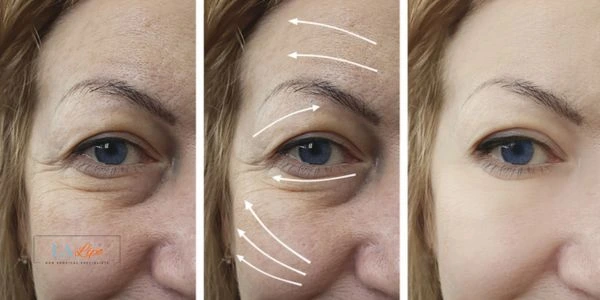 Amazing eye lift Morpheus 8 results Richmond