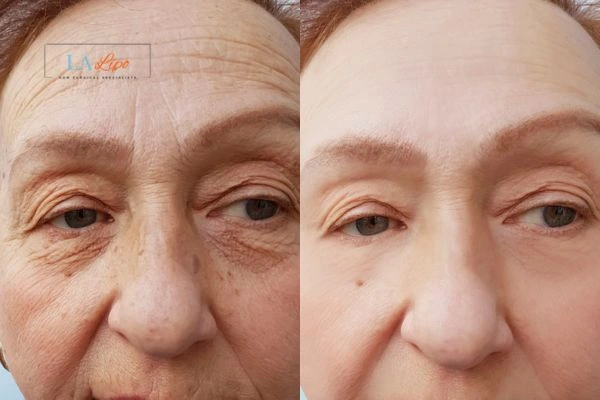 The powerful benefits of Morpheus8 Treatment Richmond - Call Our team today!