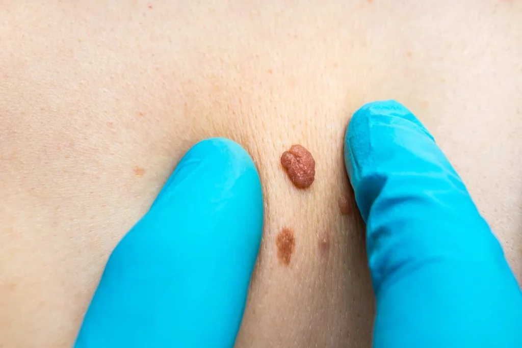 LA LIPO Cryopen Lesion Removal Prices Richmond