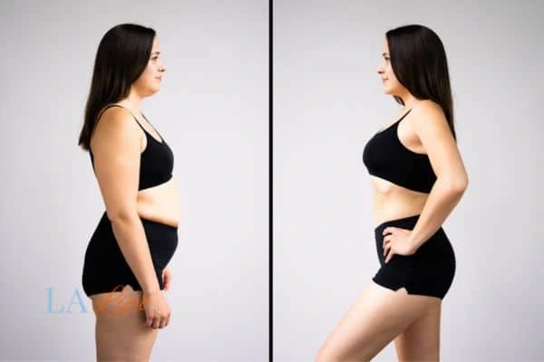 Picture of womans before and after using LA-EMS body sculpting to improve her core strength Richmond