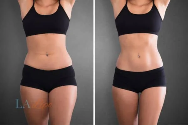 before and after results of non-surgical treatment to help a woman's body image and mental health Richmond