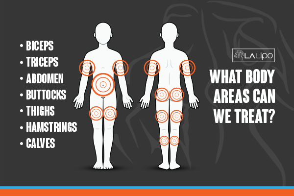 Diagram to show areas you can have LA-EMS Body Sculpting Treatment Richmond