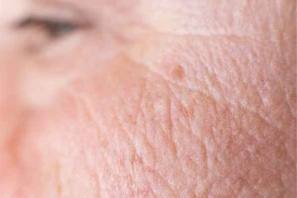 close up picture of a woman's face showing an age spot Richmond