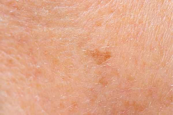close up picture of age spots Richmond