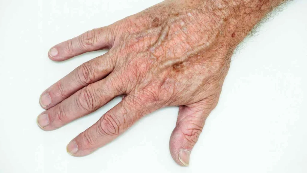 Male hand showing age spot Richmond
