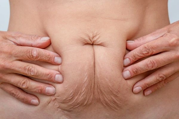 Image of a woman's stomach with loose skin - example of skin tightening Richmond options