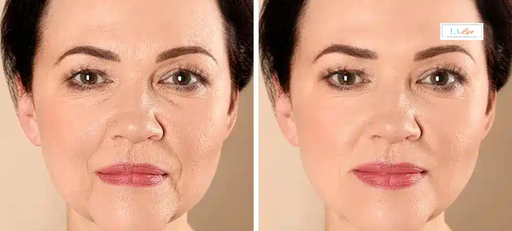 How Long Does It Take to See Results and How Long Do They Last Richmond?